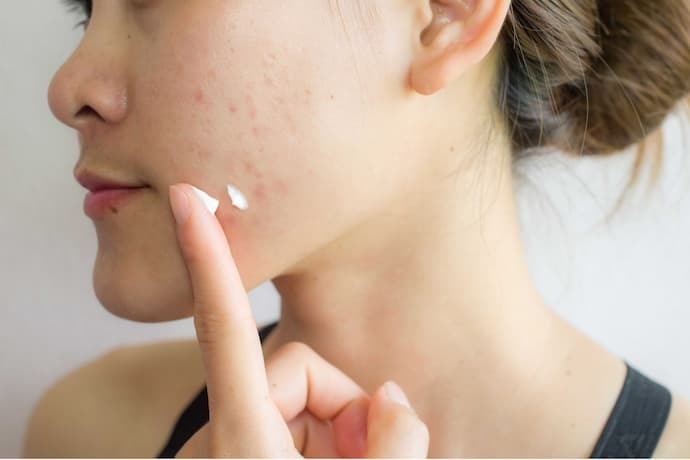 Mulher com acne aplicando creme facial